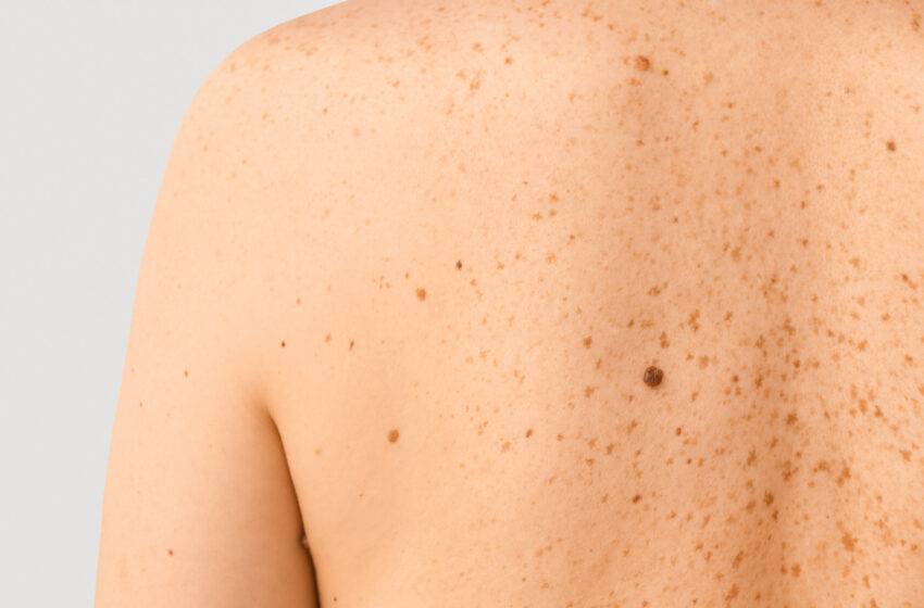  Dezembro Laranja: conscientização sobre a prevenção do câncer de pele